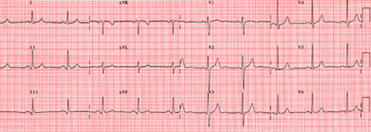 ECG-normale