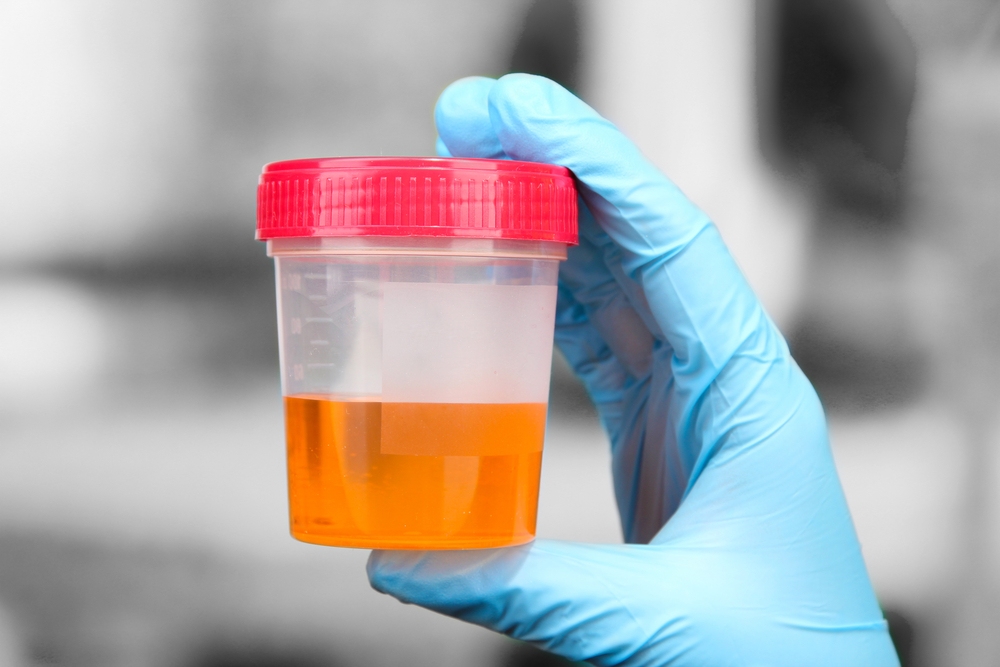 what causes blood in the urine what causes blood in the urine