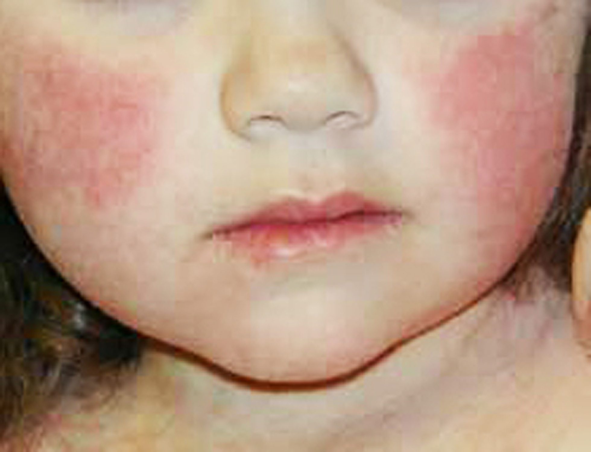 Parvovirus B19 Quinta Malattia GravidanzaOnline