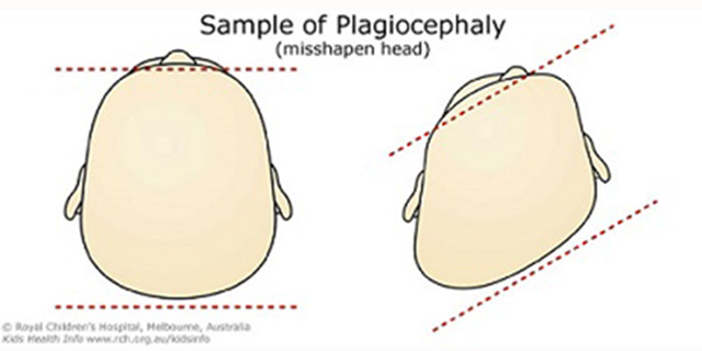 plagiocefalia
