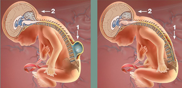 spina bifida