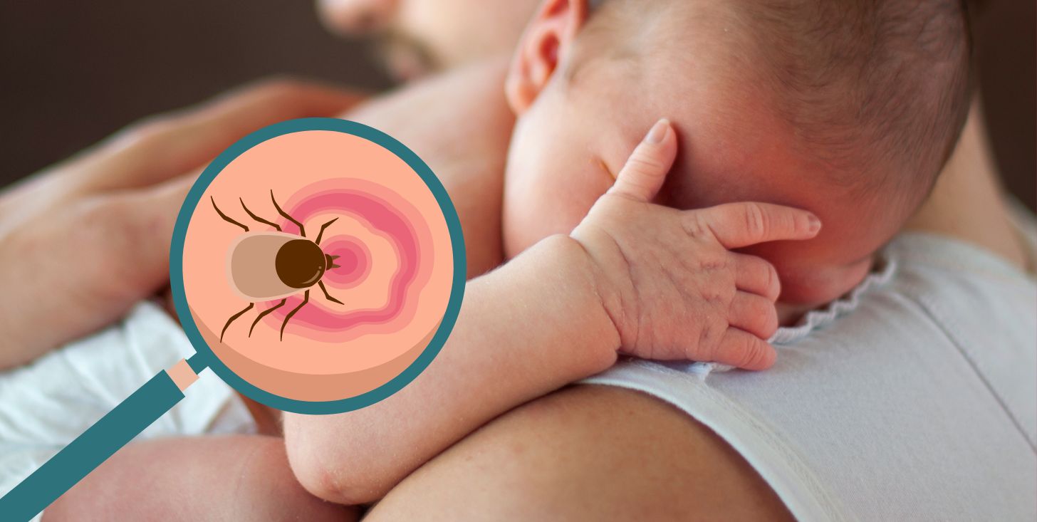 Cose da sapere sulla Borreliosi o Malattia di Lyme in neonati e bambini