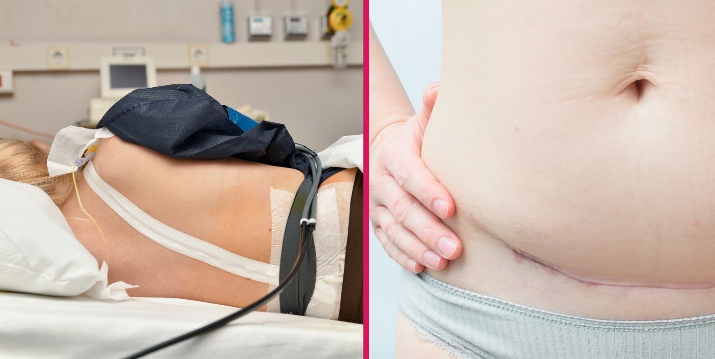 Parto naturale o cesareo? Con epidurale o senza? Stereotipi e miti sul parto naturale