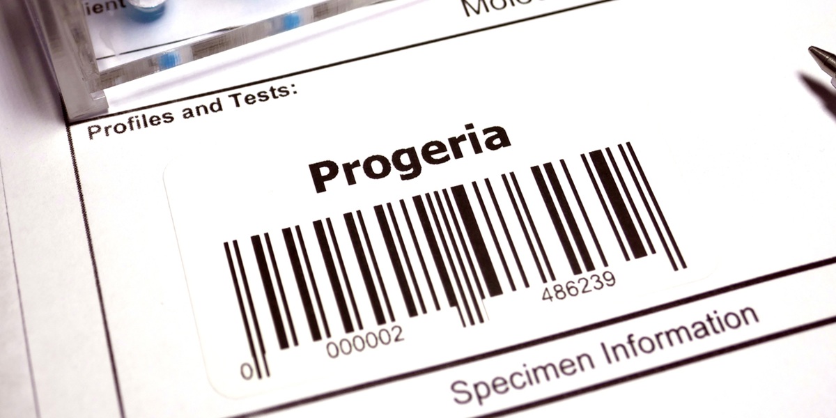 cosa significa avere la progeria quando il corpo invecchia precocemente da Gravidanzaonline.it cosa significa avere la progeria quando il corpo invecchia precocemente